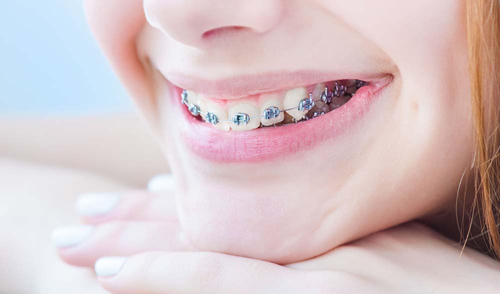 علت فاصله دندانی چیست؟