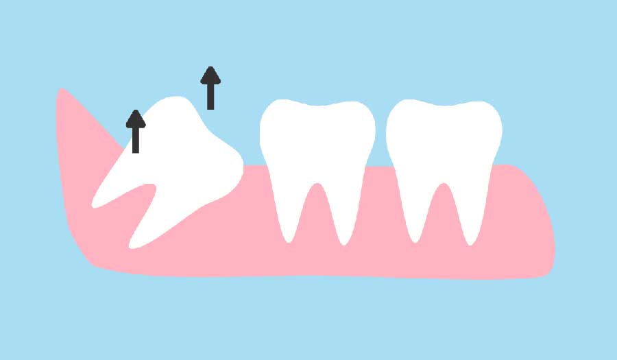 بهترین زمان کشیدن دندان عقل
