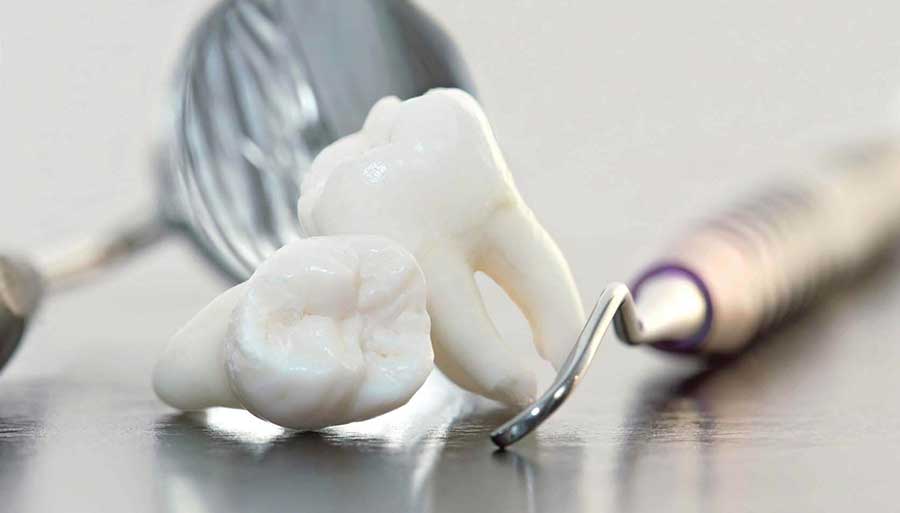 كشيدن دندان عقل چه عوارضی دارد؟