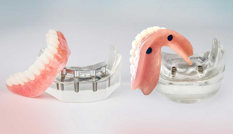 چرا ایمپلنت دندان پیشنهاد می شود؟