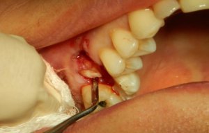 چطور از خونریزی پس از کشیدن دندان جلوگیری کنیم؟